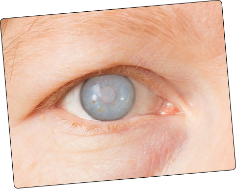 Close-up of an eye with a cataract