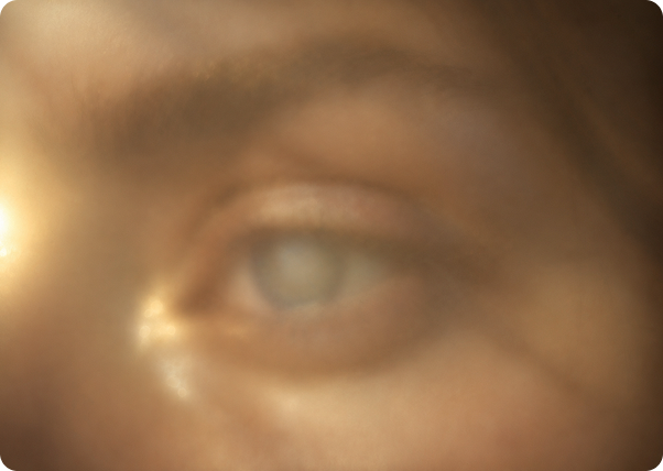 Close-up of an eye with dulled color