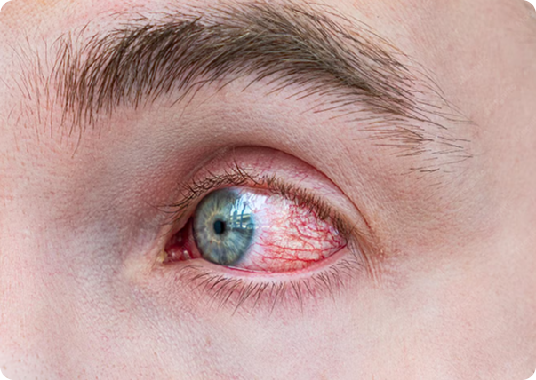 Close-up of an injured eye
